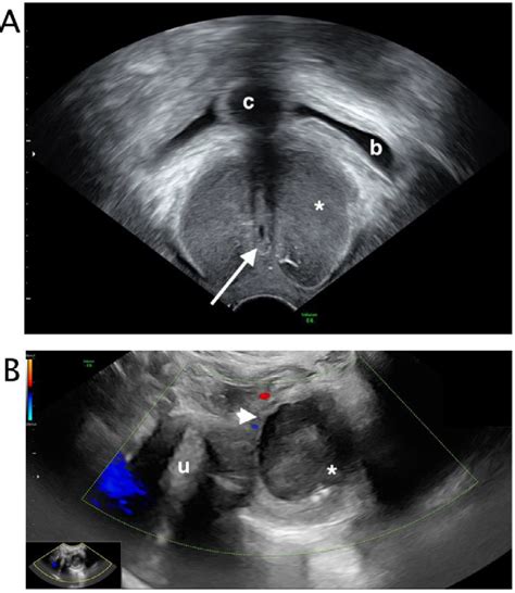 glande de skene|Skenes Gland: What Theyre For, Cyst Symptoms & Treatment